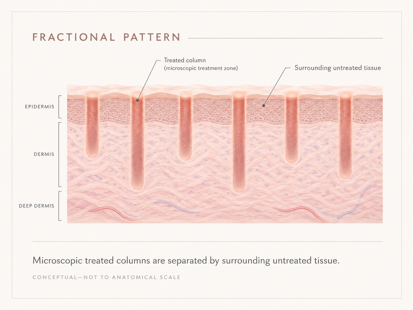 Educational graphic showing microscopic fractional laser treatment columns surrounded by untreated skin