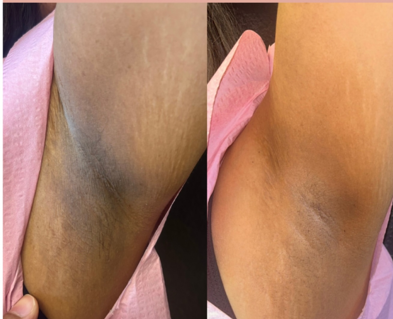 Grace MedSpa patient before and after underarm skin lightening treatment in Austin