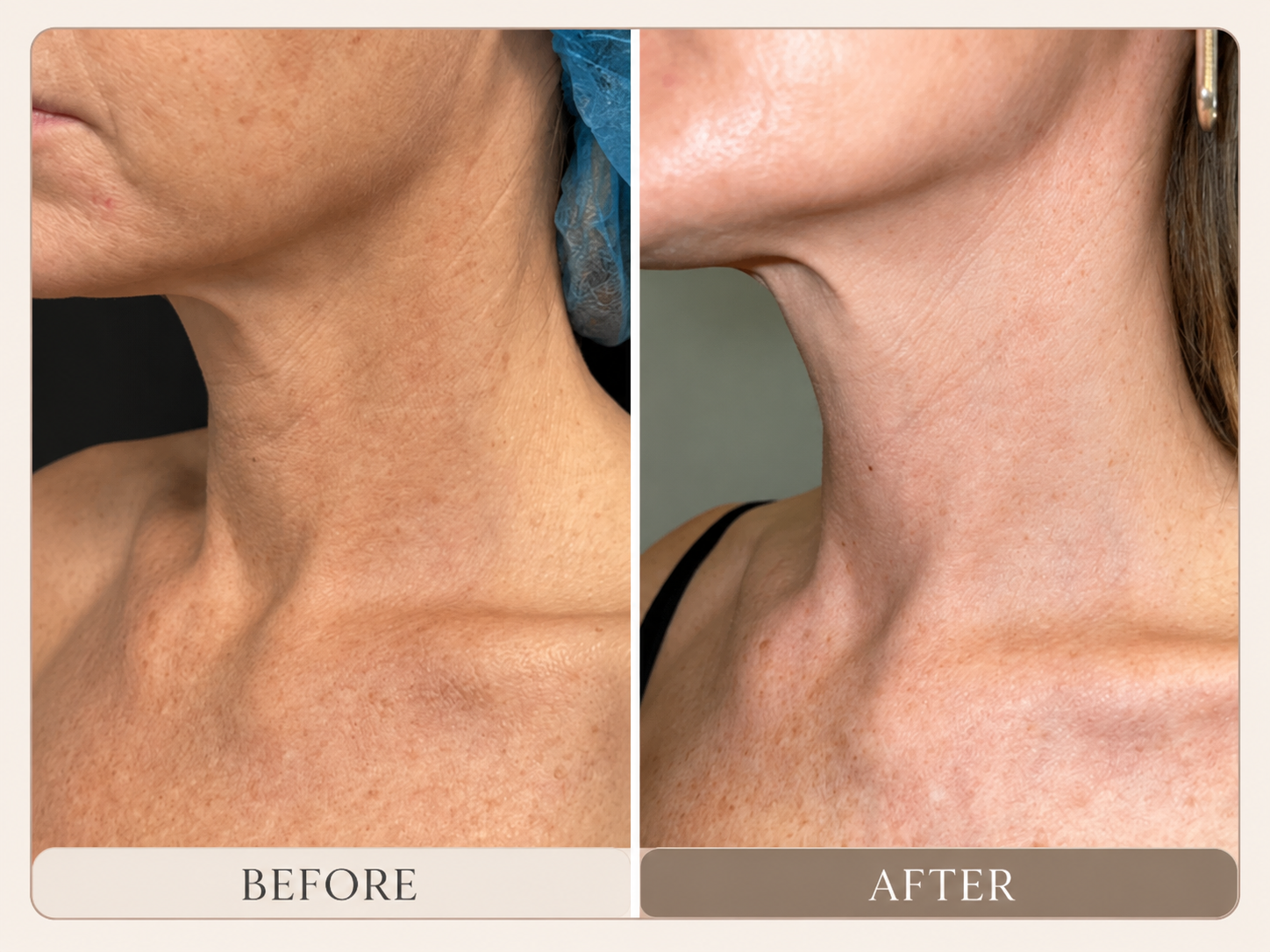 Before-and-after showing neck texture following one MultiFrax session