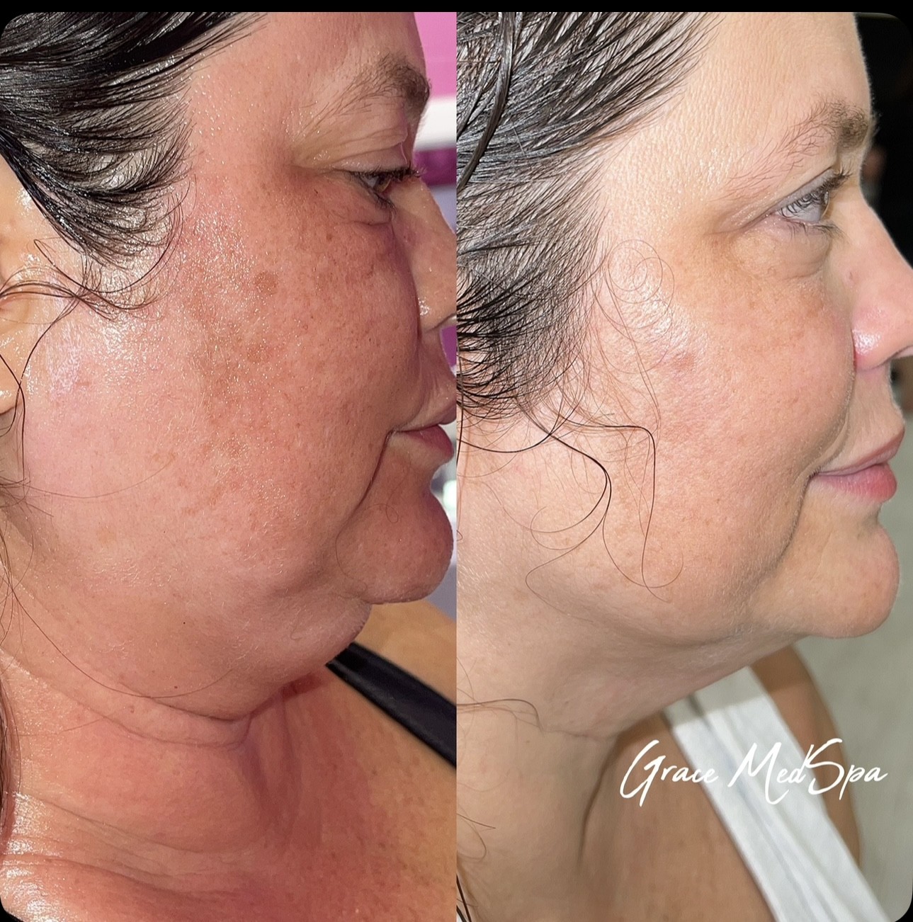 Before and after the first Morpheus8 face and neck session at Grace Med Spa in Austin, primary view