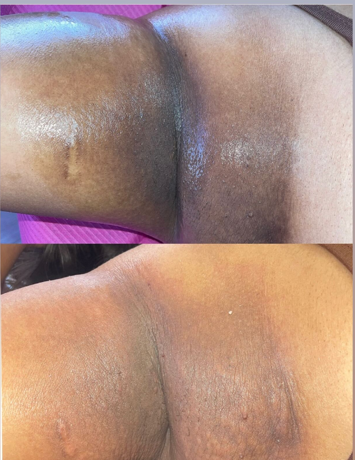 Second Grace MedSpa patient underarm skin-lightening result in Austin