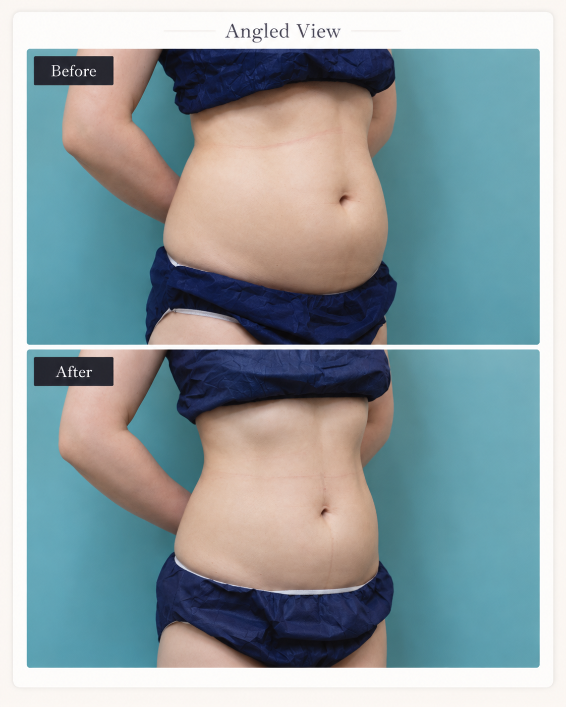 Angled abdomen and waist before and after LIPOcel treatment