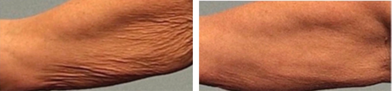Manufacturer-supplied Morpheus8 before-and-after case showing crepey skin on the inner arm