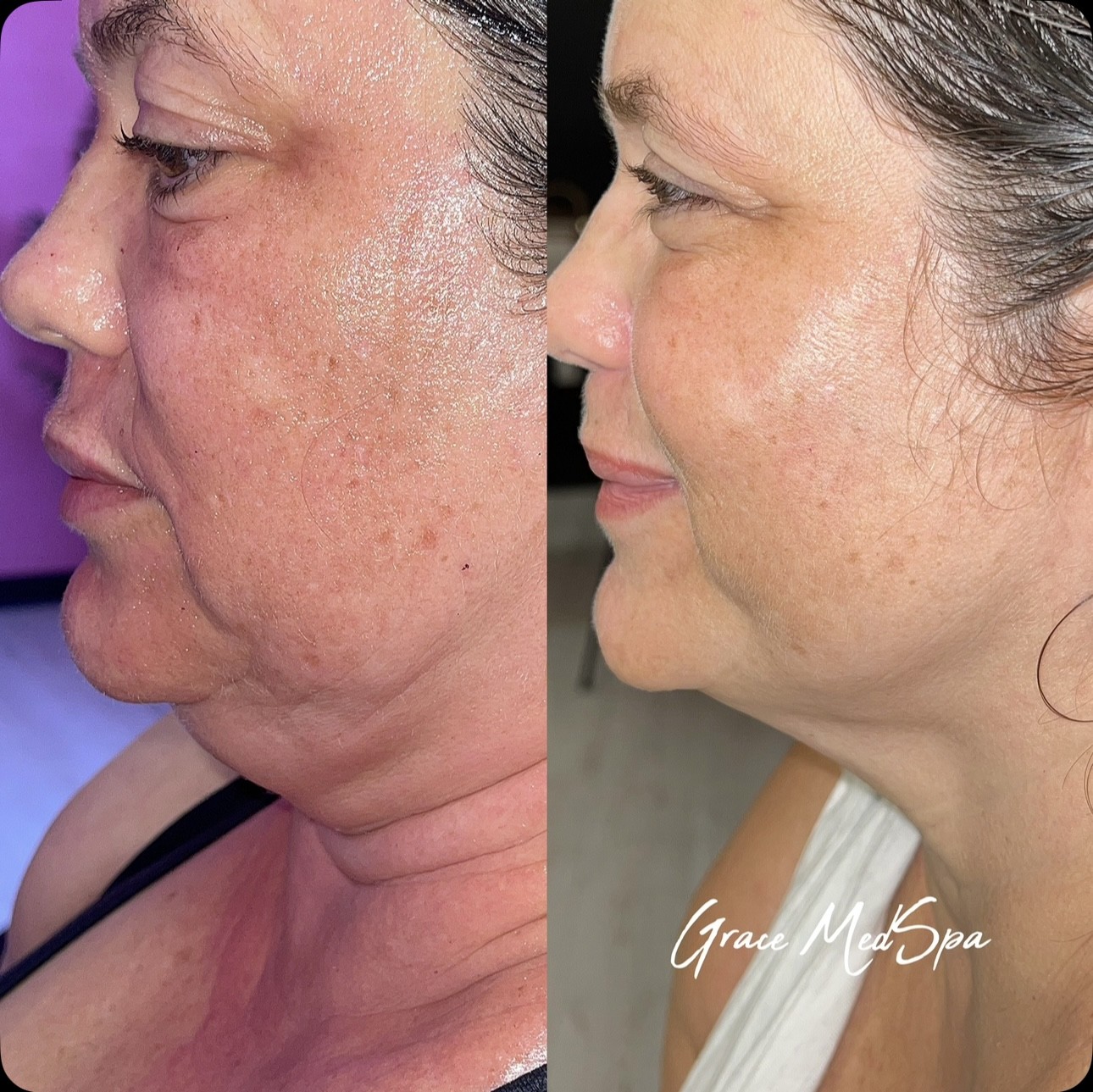 Before and after the first Morpheus8 face and neck session for the same Grace Med Spa patient, alternate view