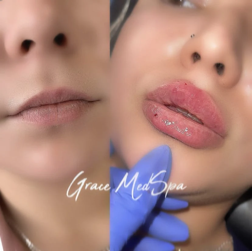 Grace patient lip filler before and after result