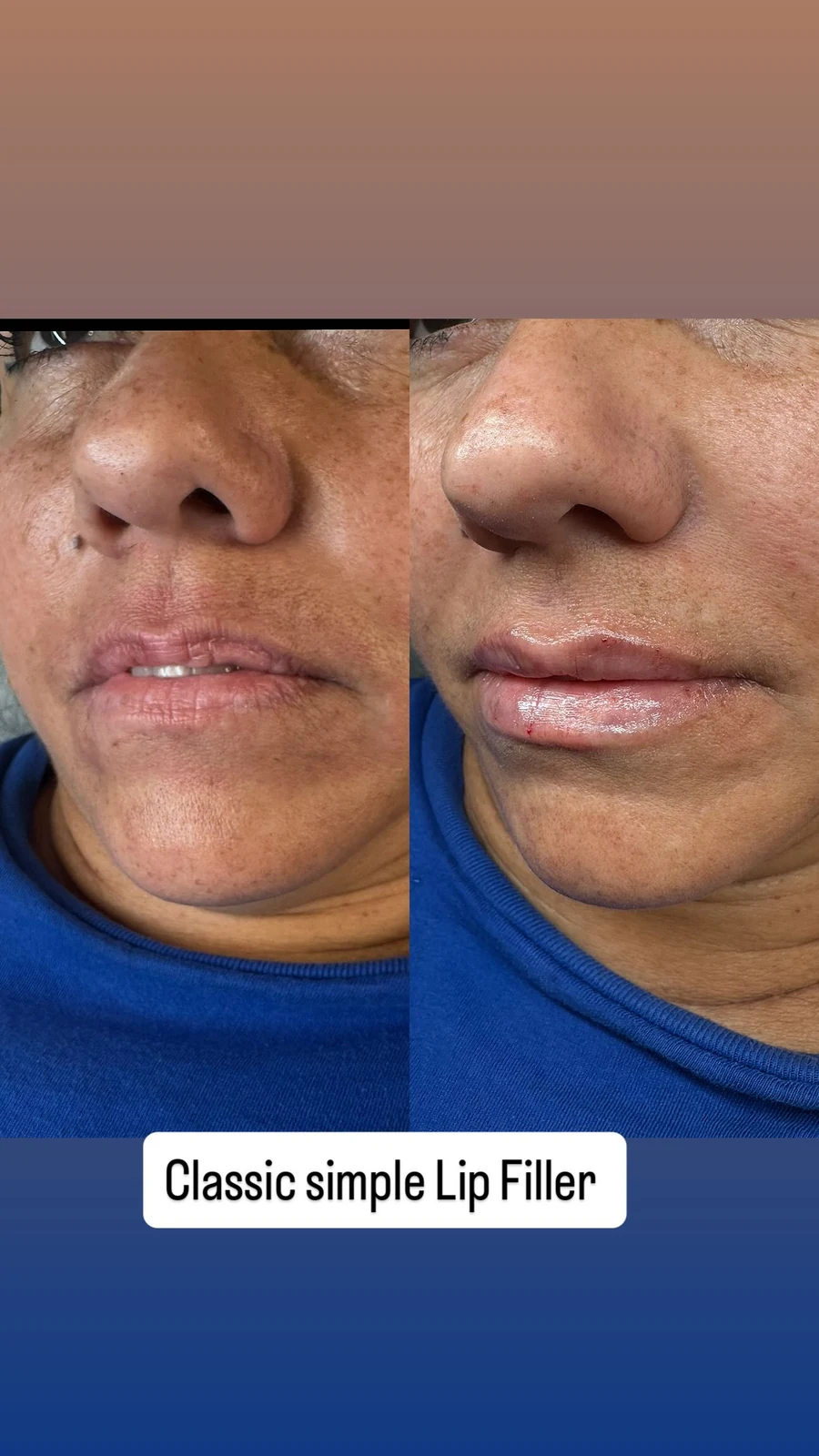 Mature Grace MedSpa patient before and after lip filler