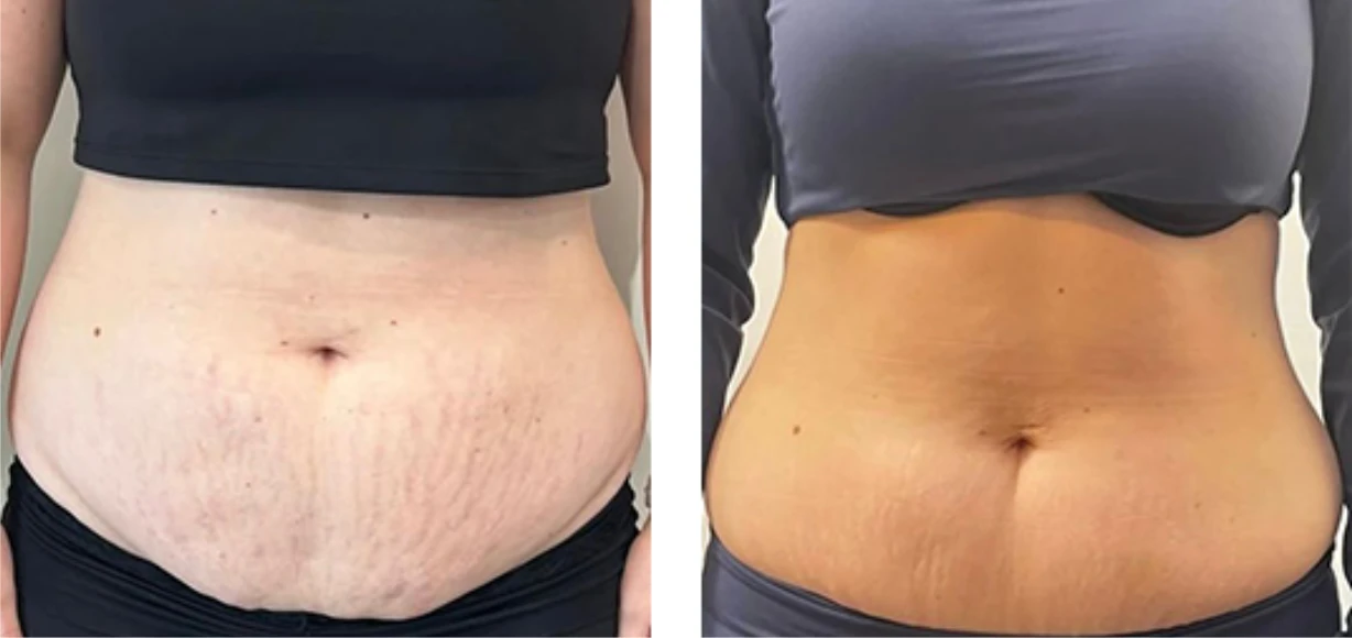Additional manufacturer-supplied Morpheus8 before-and-after case showing abdominal skin laxity
