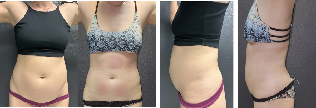 Same Grace MedSpa patient shown in EvolveX body treatment photographs