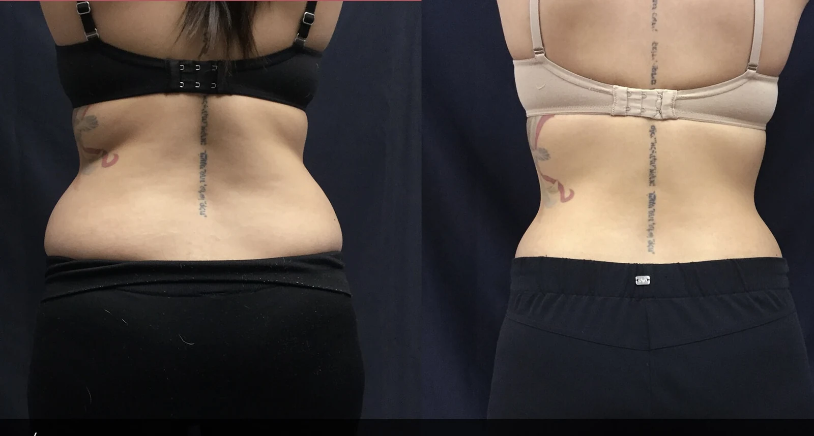 Before-and-after comparison of SculpSure treatment across the flanks and back waist