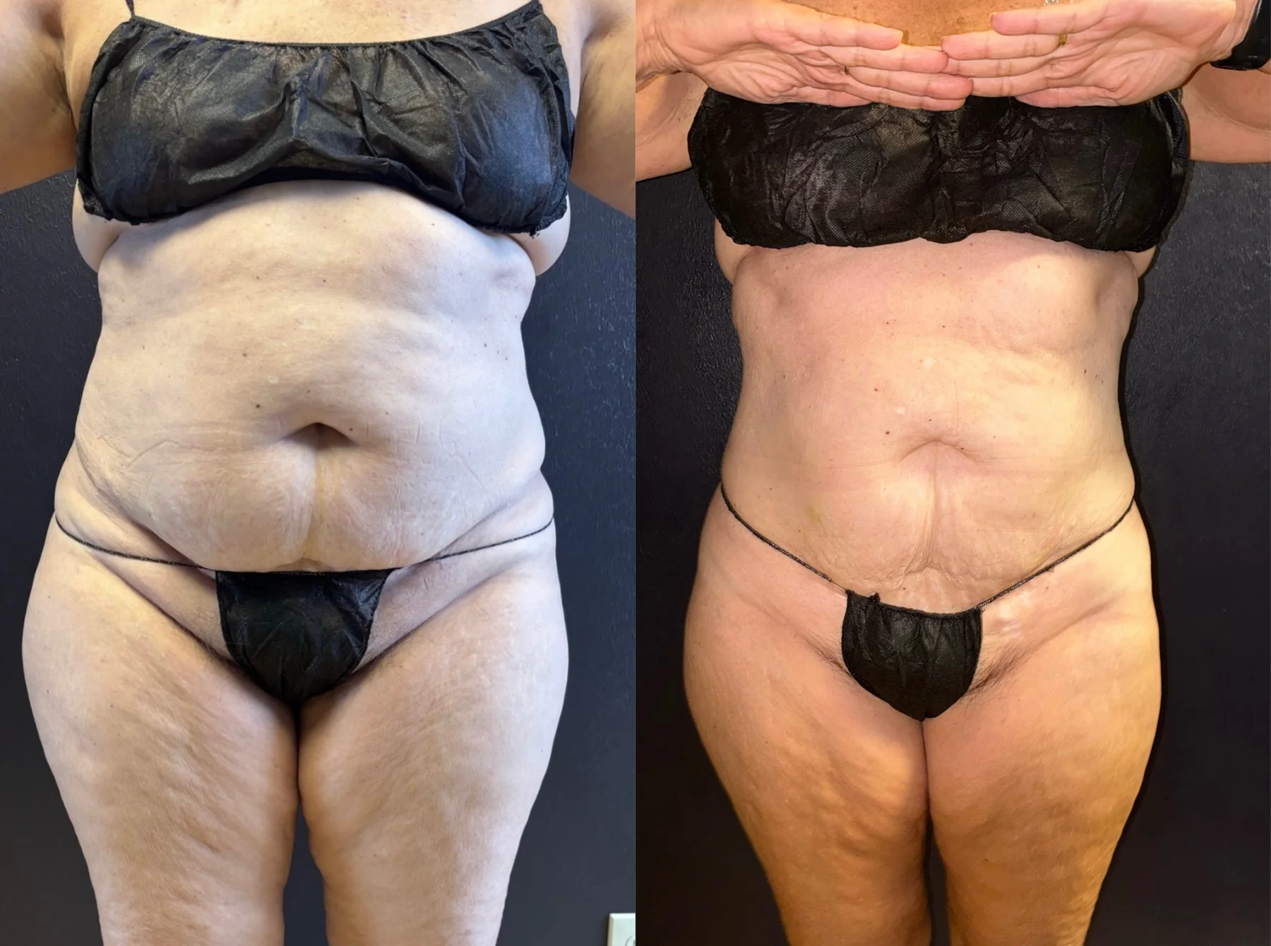 Grace MedSpa patient's abdomen before and after a body-transformation plan that included two SculpSure treatments.