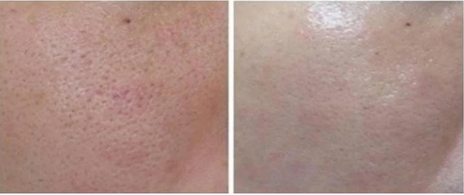 Manufacturer-supplied Morpheus8 before-and-after case showing the appearance of pores and texture
