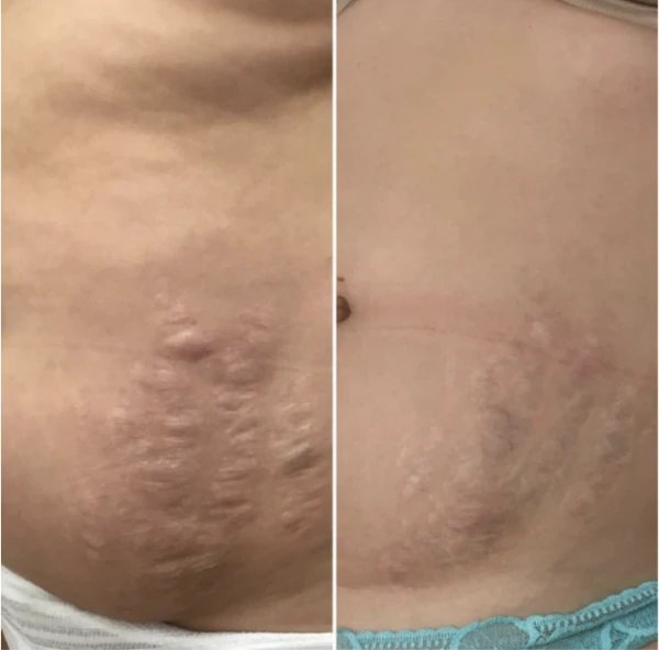 Manufacturer-supplied Morpheus8 before-and-after case showing abdominal stretch marks
