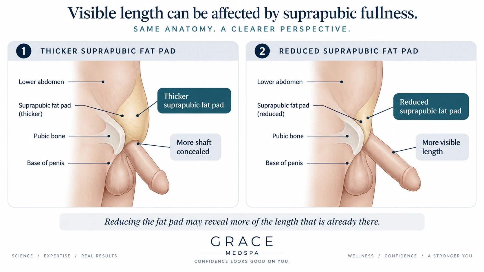 Medical illustration showing how suprapubic fat can conceal existing penile length