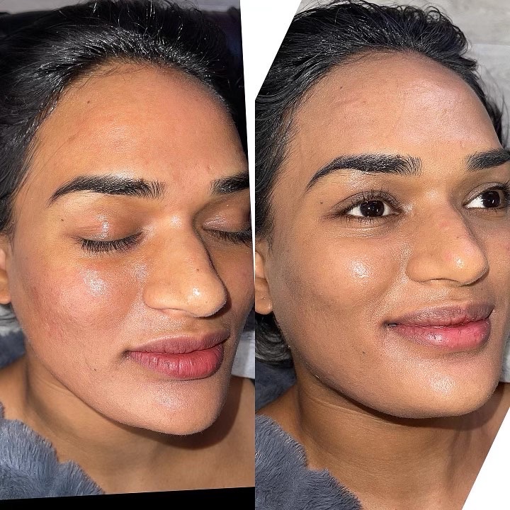 Real Grace MedSpa patient receiving pigment-focused care with Lutronic Spectra in Austin