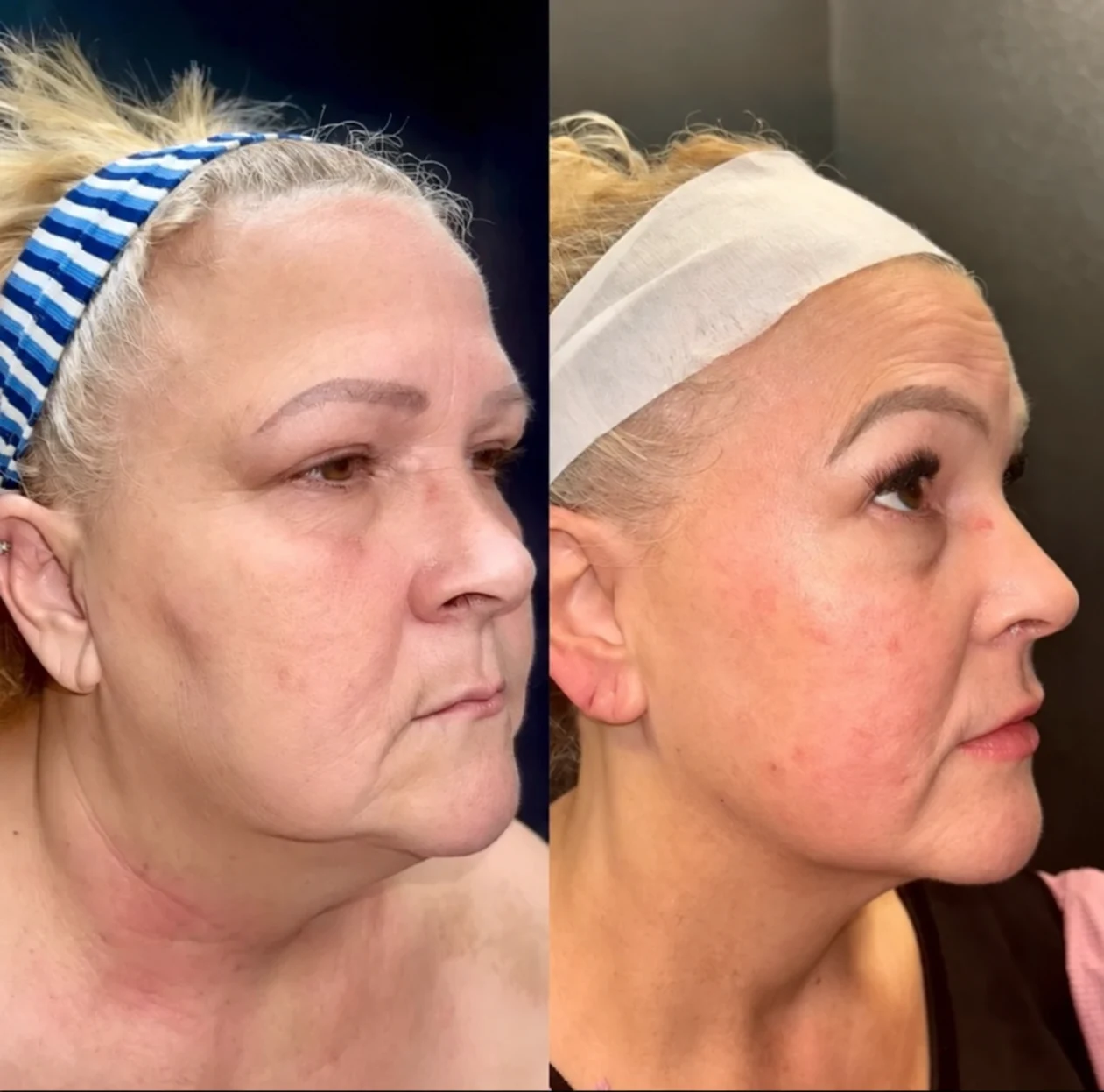 Grace MedSpa patient before and after approximately 50-pound GLP-1 weight loss with three Morpheus8 face and neck treatments and lip filler, right profile view.