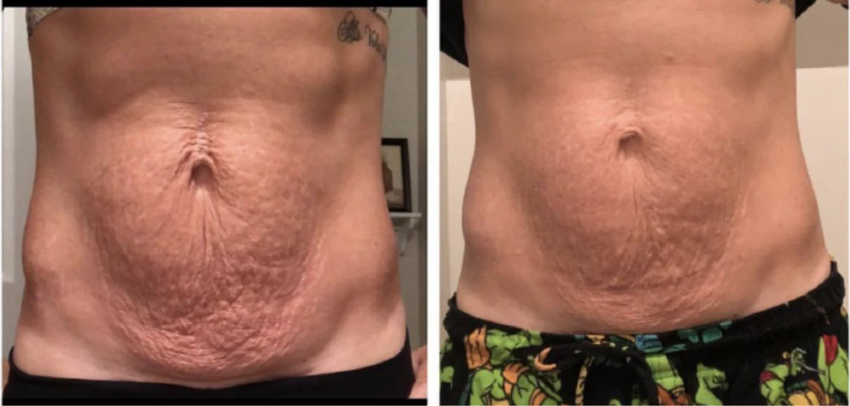 Manufacturer-supplied Morpheus8 before-and-after case showing abdominal skin laxity