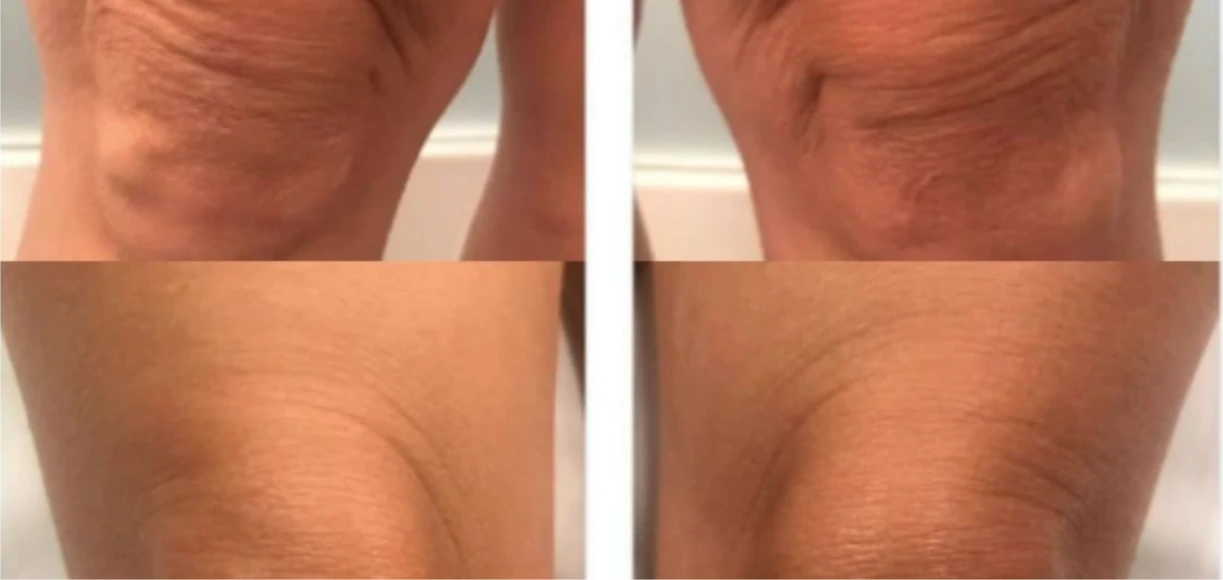 Manufacturer-supplied Morpheus8 before-and-after case showing skin laxity above the knees