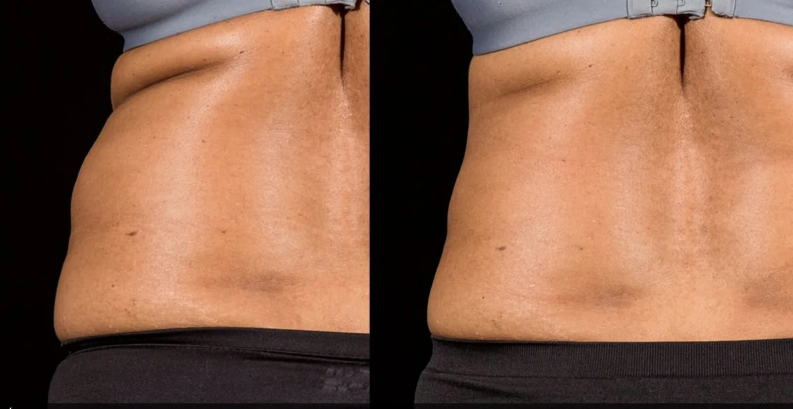 Before and after side views of flank contour for a Grace MedSpa SculpSure patient after two rounds of SculpSure