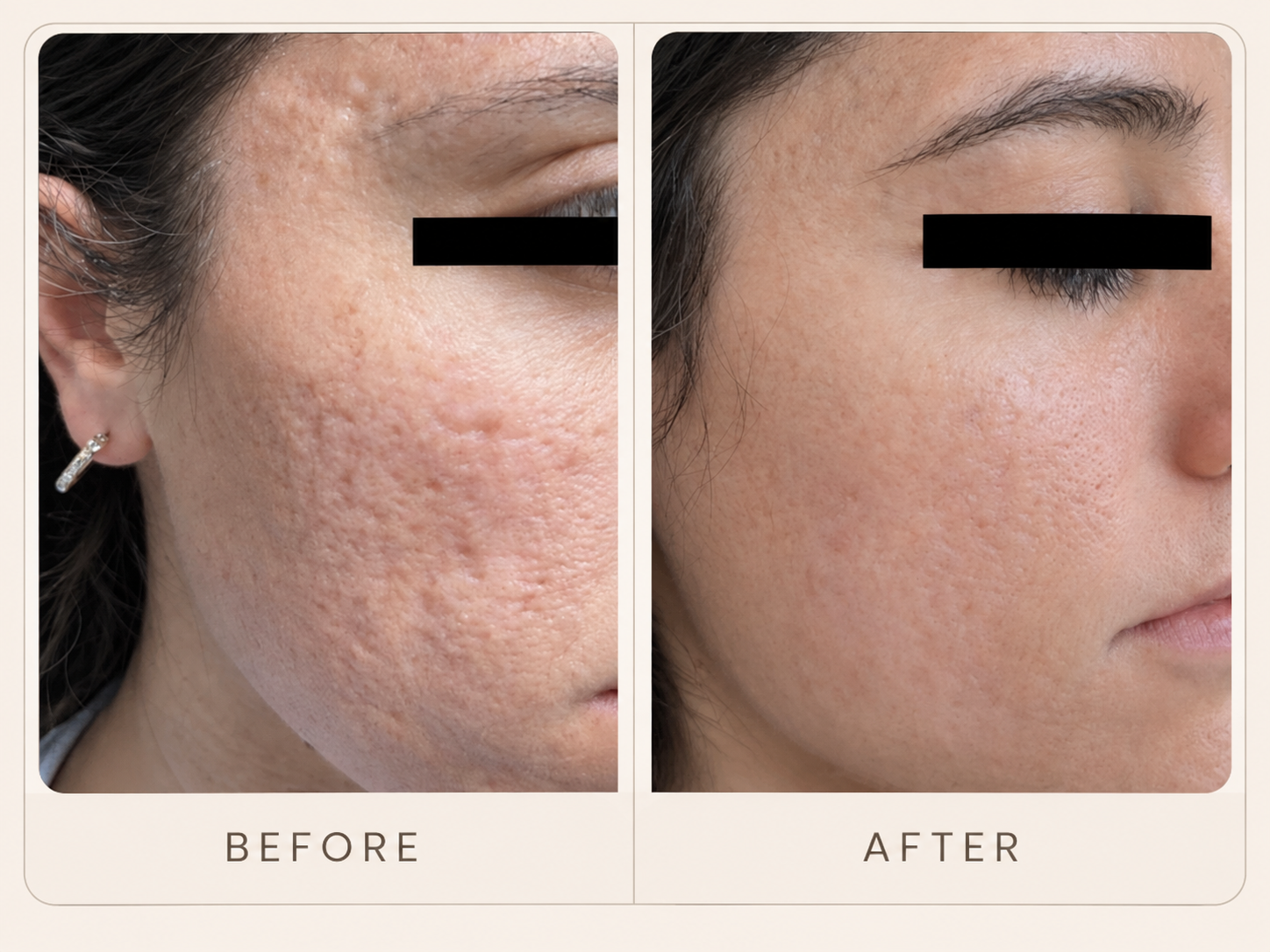 Before-and-after showing facial texture following two MultiFrax sessions