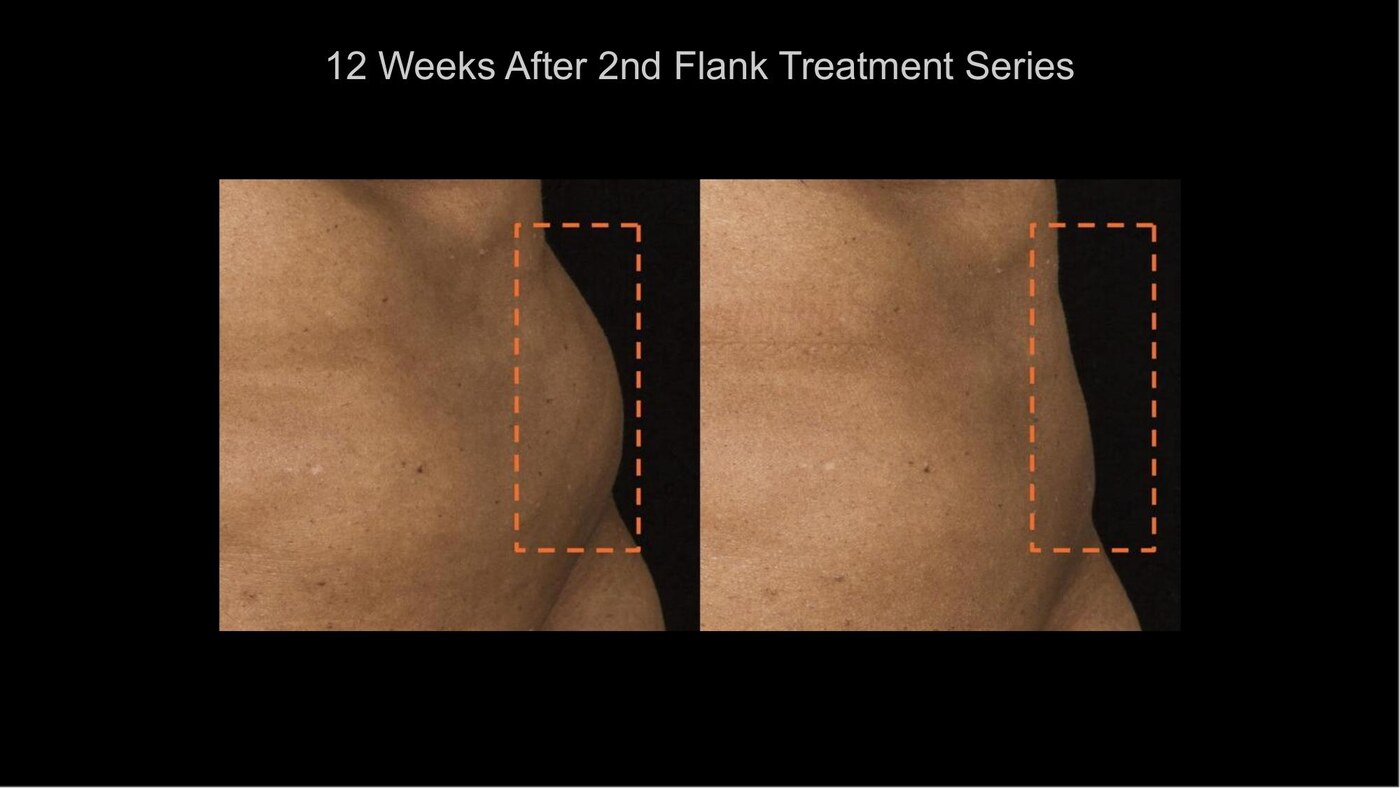 Manufacturer-supplied SculpSure before-and-after case showing the abdomen 12 weeks after a second treatment series