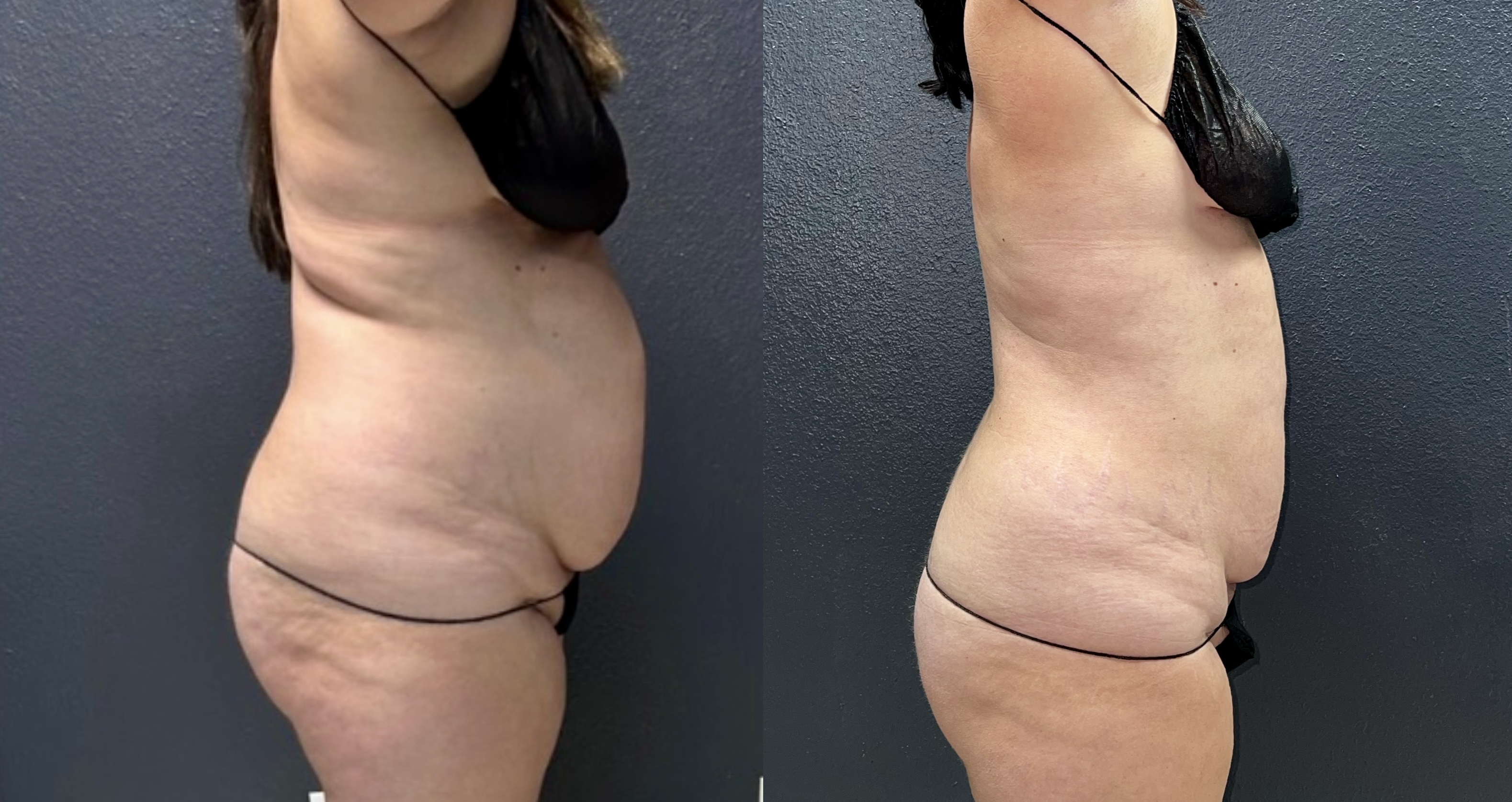 Grace patient abdominal before-and-after comparison following a combination EvolveX and Morpheus8 plan