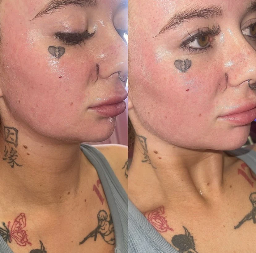 Grace patient before and after multi-area facial balancing with jawline, lip and profile filler