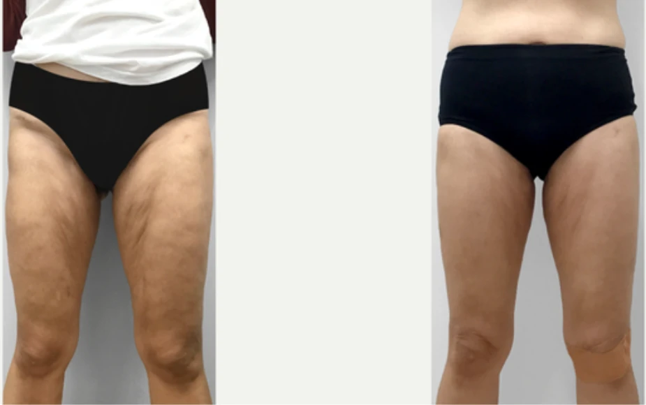 Manufacturer-supplied Morpheus8 before-and-after case showing inner-thigh skin laxity
