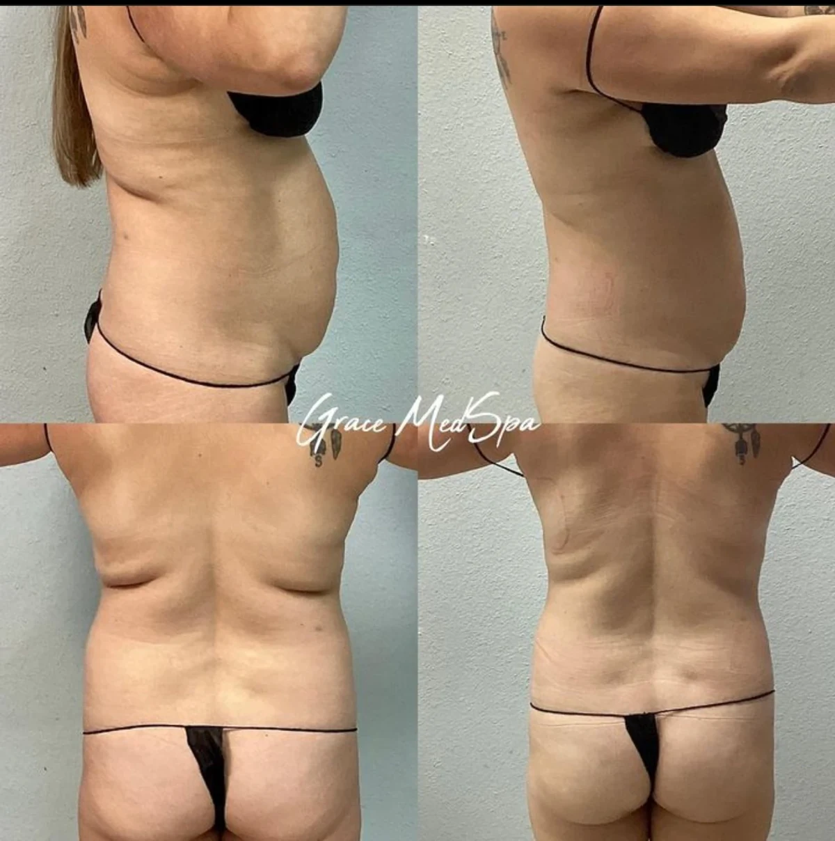 Grace patient six-session DreamBody Sculpting comparison of the abdomen and waist from multiple views