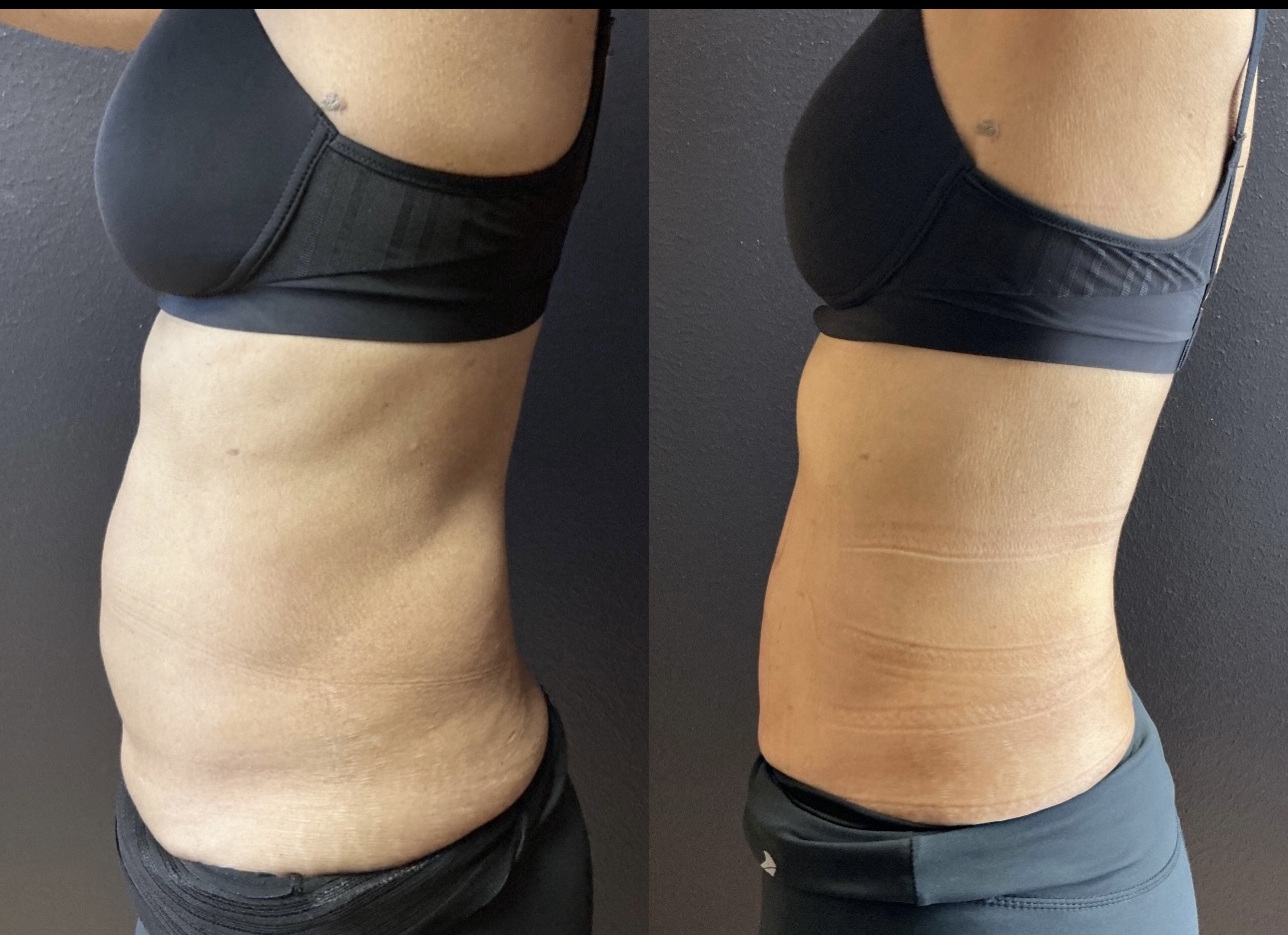 Grace MedSpa abdomen fat-dissolving treatment result shown side by side