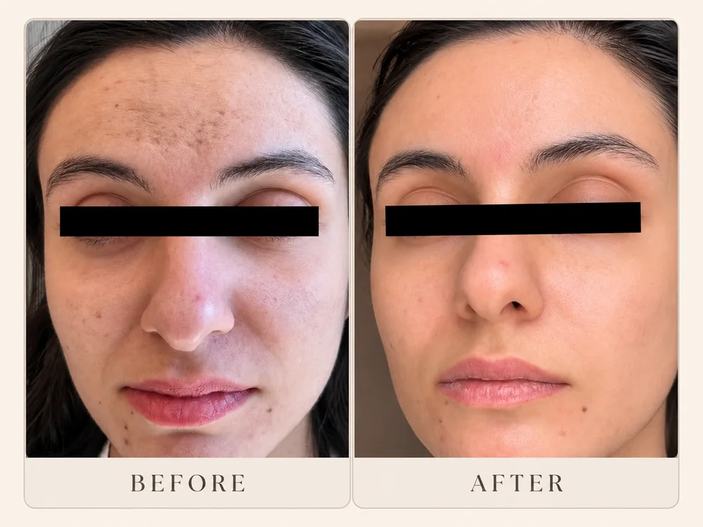 MultiFrax before-and-after showing facial tone and visible pigmentation one week after one session