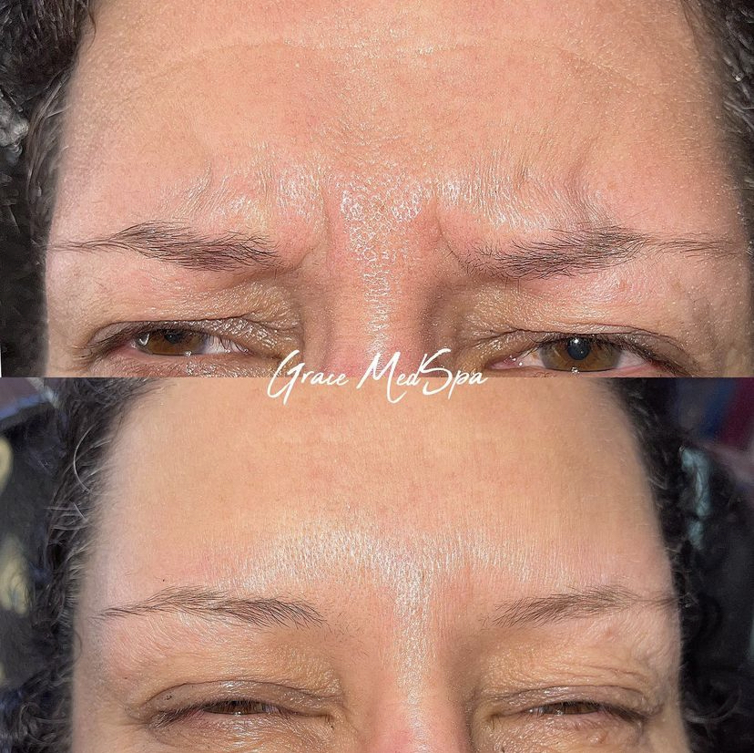 Grace patient frowning before and after Botox for glabellar lines