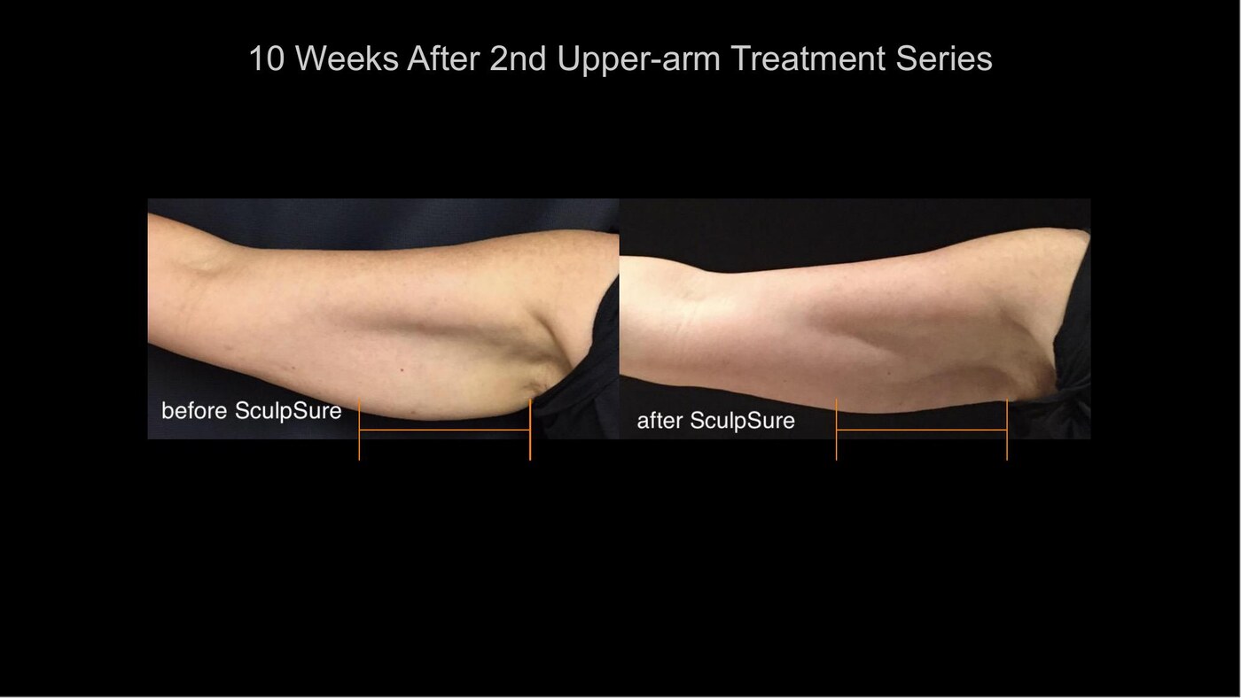 Manufacturer-supplied SculpSure before-and-after case showing upper arms 12 weeks after a second treatment series