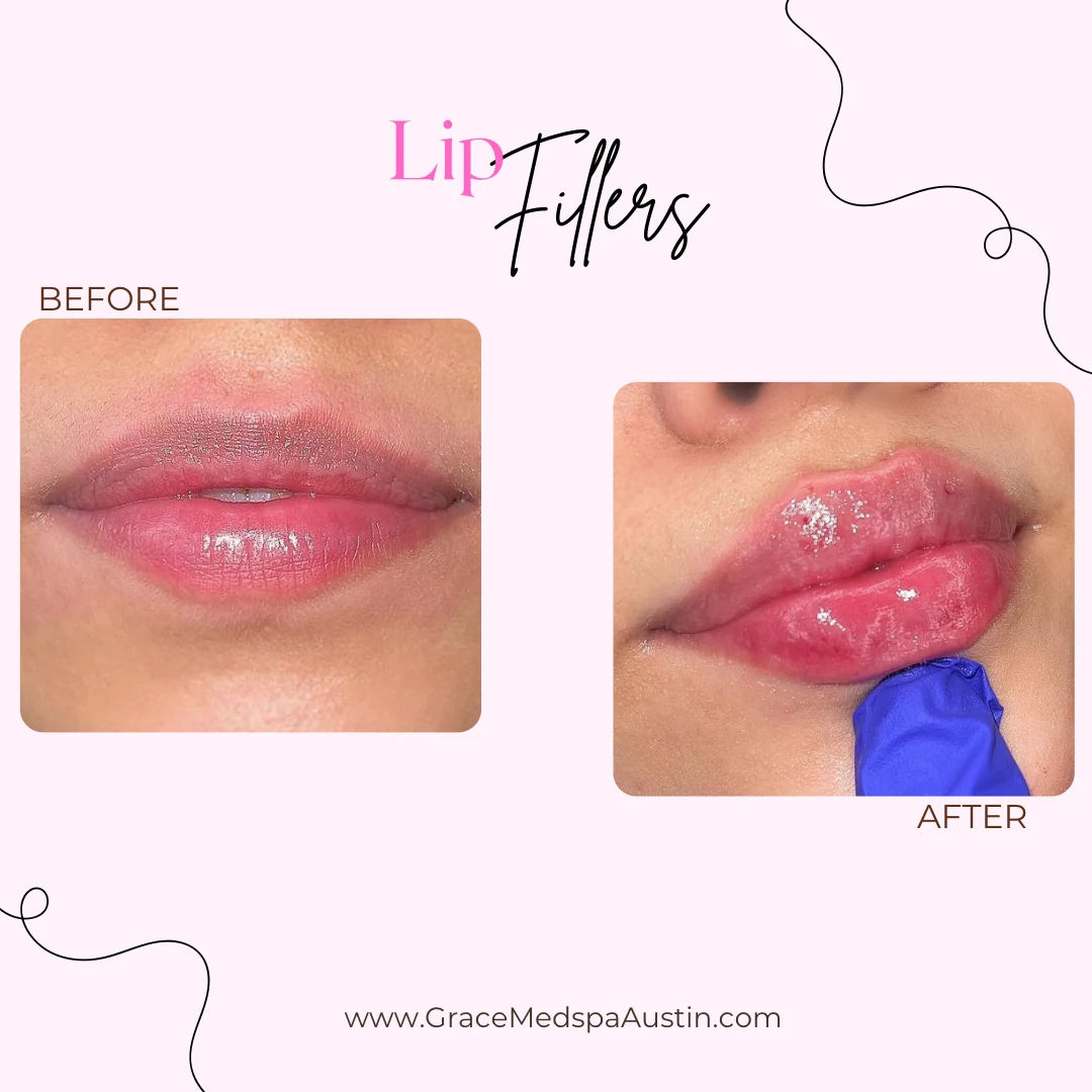 Grace patient before and after natural-looking lip filler