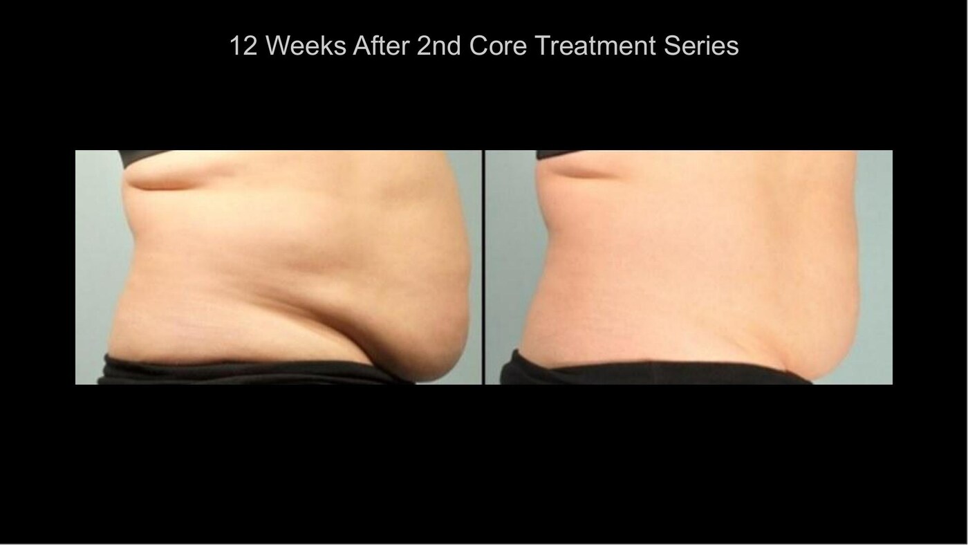 Manufacturer-supplied SculpSure before-and-after case showing the flanks 12 weeks after a second treatment series