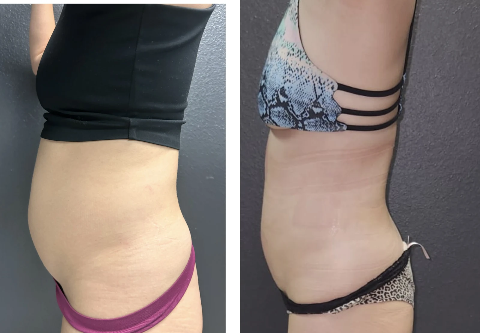 Grace patient side-profile before-and-after comparison following EvolveX body contouring