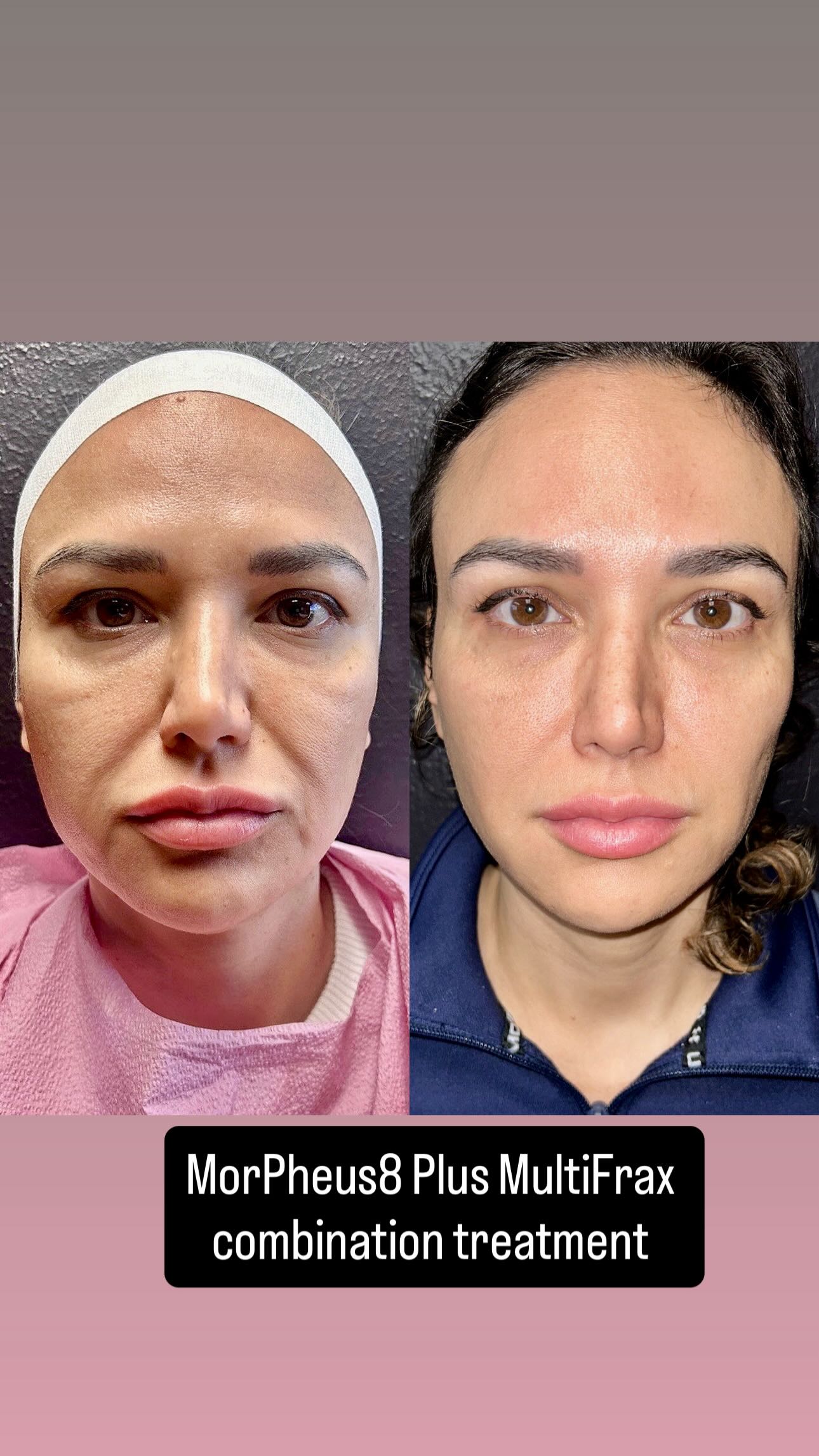 Actual Grace MedSpa patient before-and-after following a Morpheus8 and MultiFrax combination plan