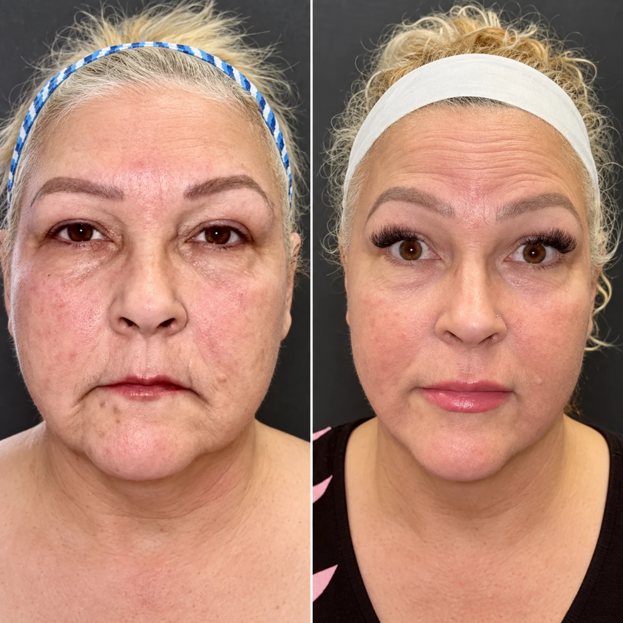 Grace MedSpa patient during a GLP-1 weight-loss journey after three Morpheus8 face and neck treatments and lip filler, front before-and-after view.