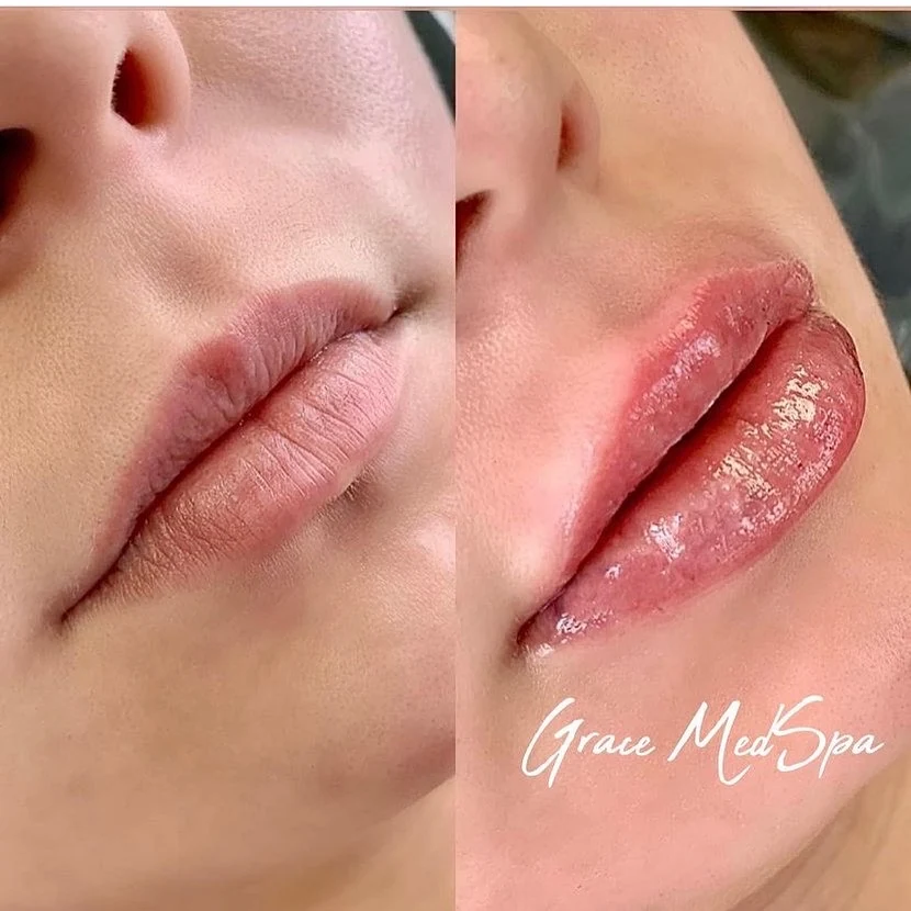 Close-up lip filler before and after showing shape and definition at Grace MedSpa