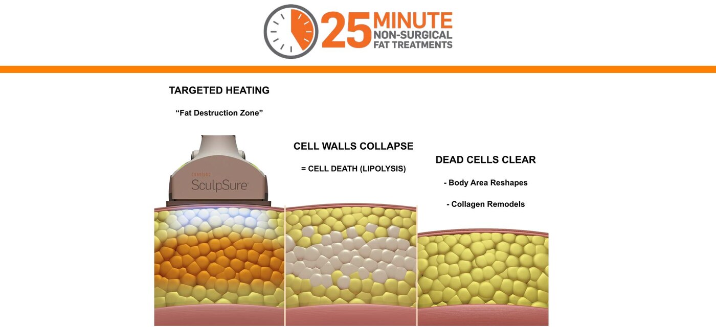 Manufacturer diagram showing targeted heating of fat cells, cell wall collapse and gradual clearance after SculpSure