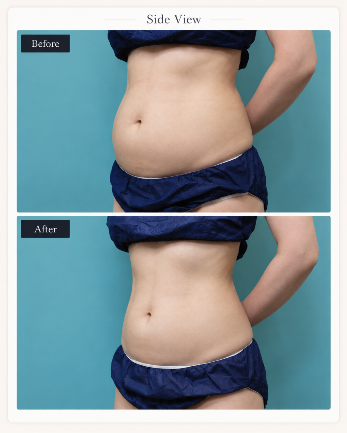 Side-profile abdomen before and after LIPOcel treatment