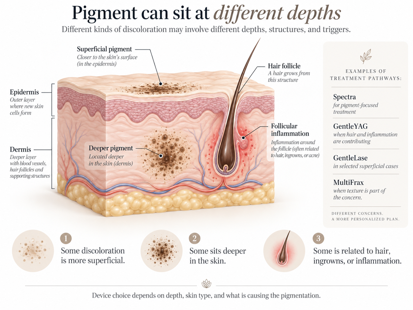 Skin diagram showing superficial and deeper pigmentation and follicular inflammation