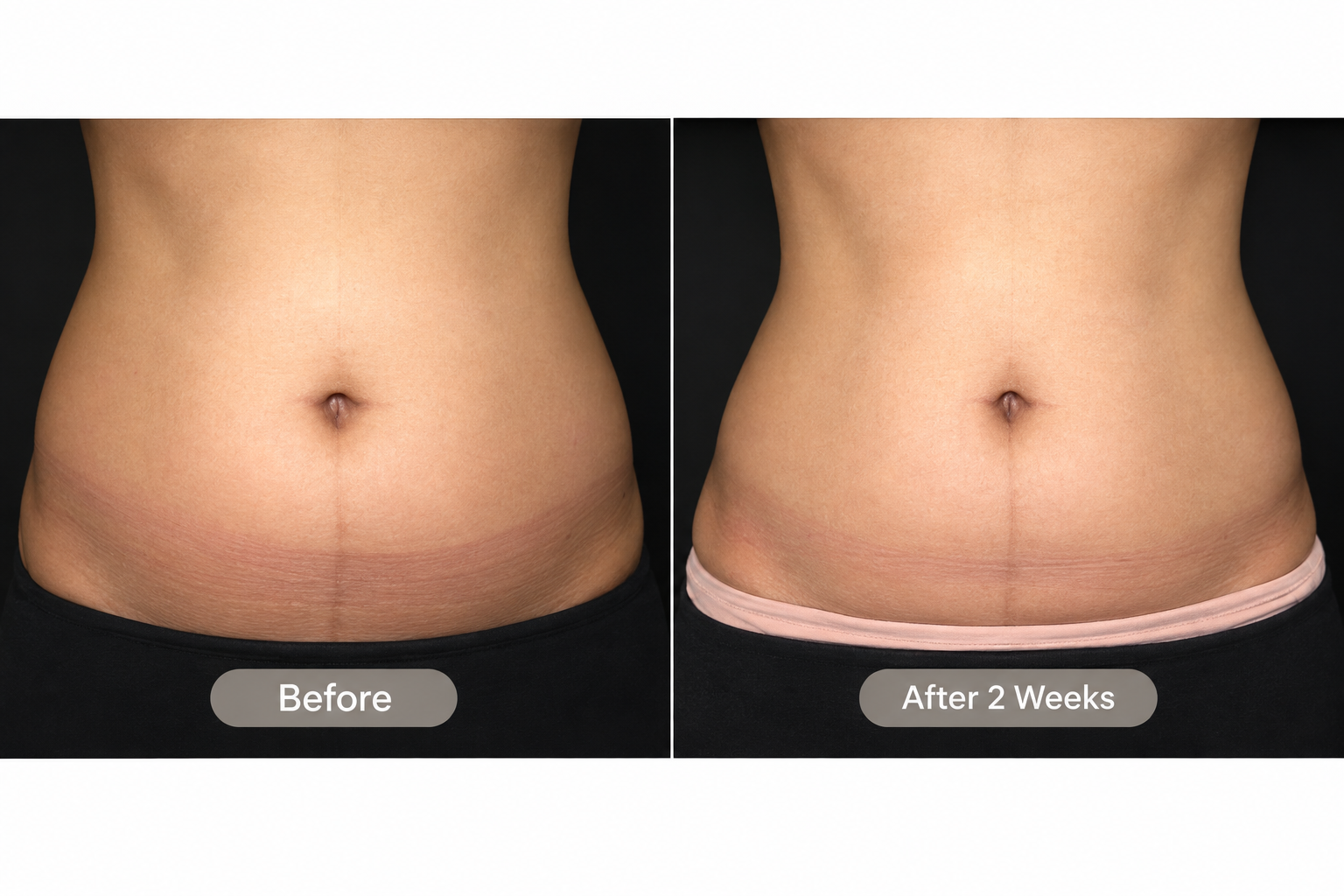 Straight-on abdomen before and after LIPOcel treatment at two-week follow-up