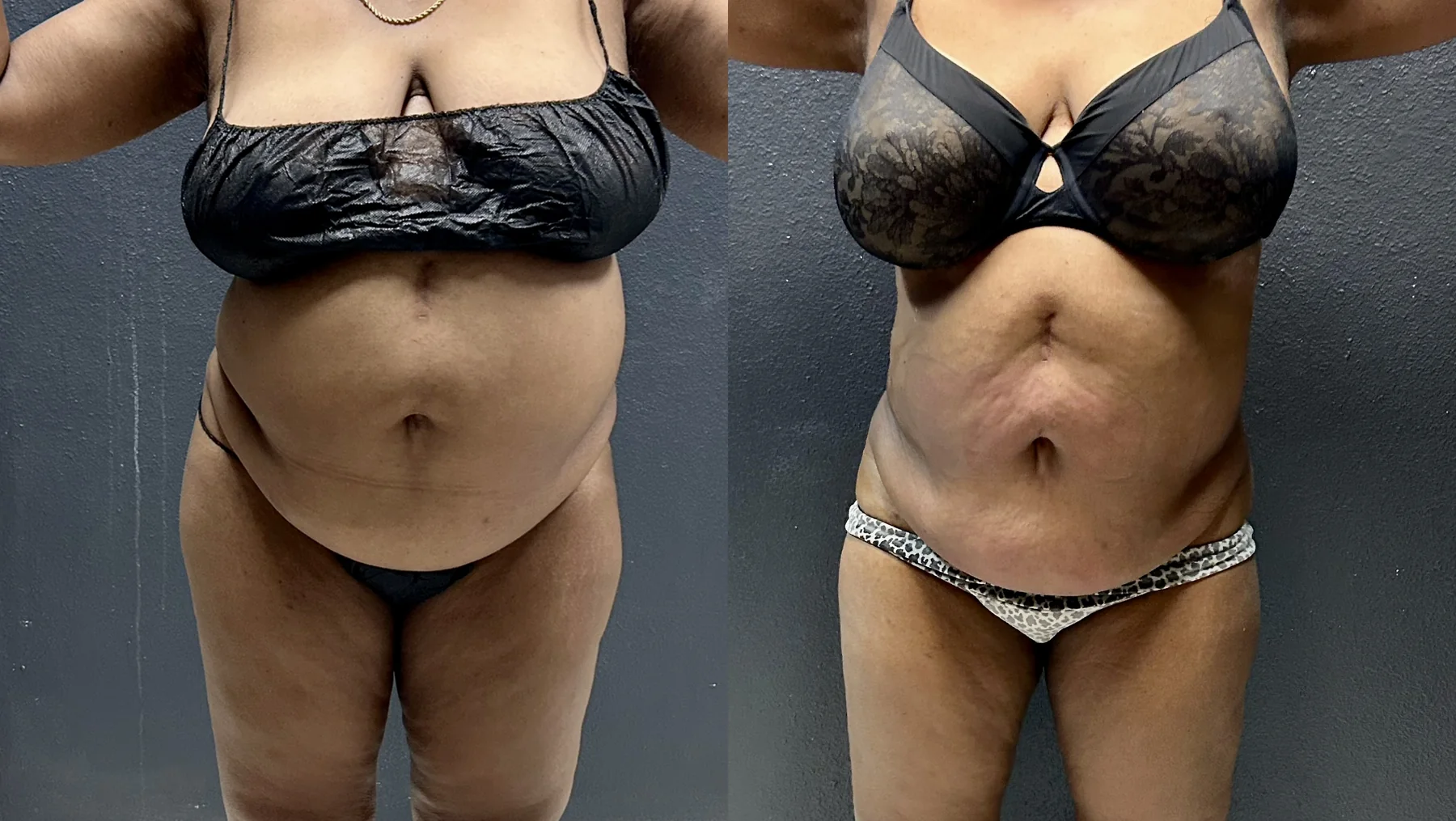 Actual Grace MedSpa DreamBody and EvolveX abdominal contour result in Austin