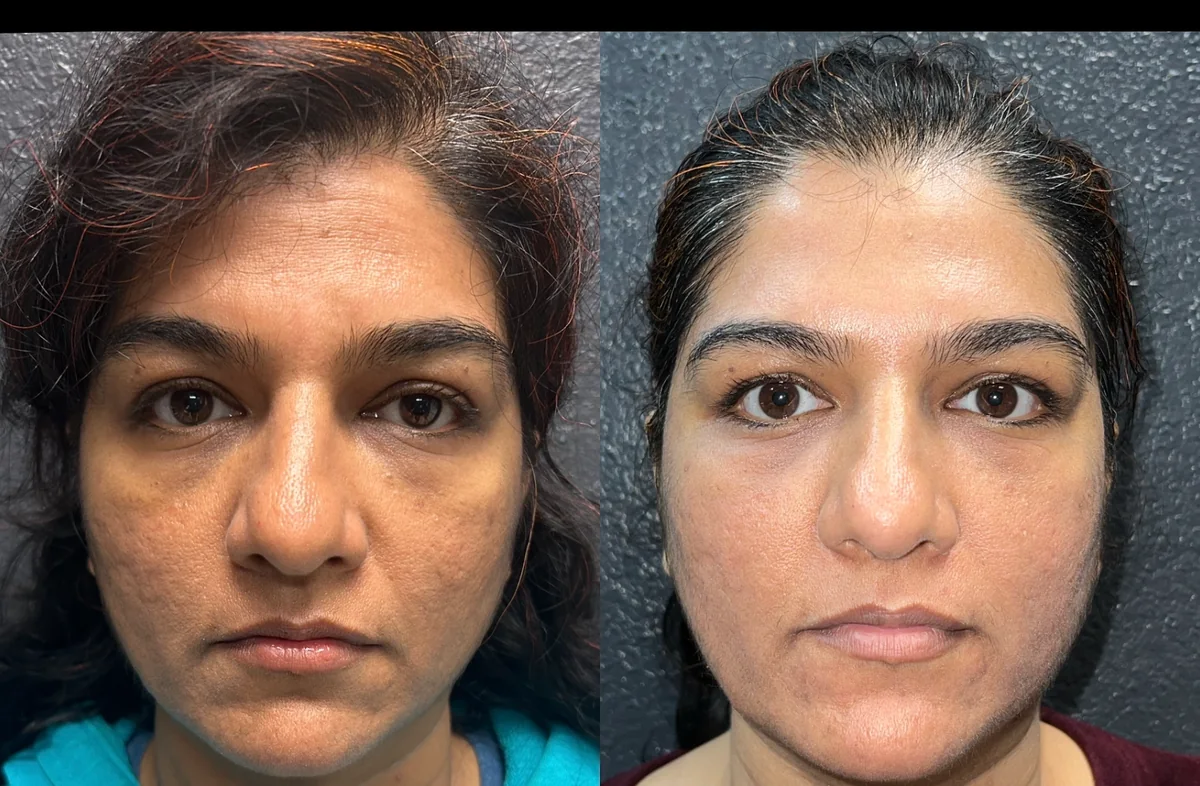 Lutronic Spectra pigment and skin-quality result at Grace MedSpa in Austin