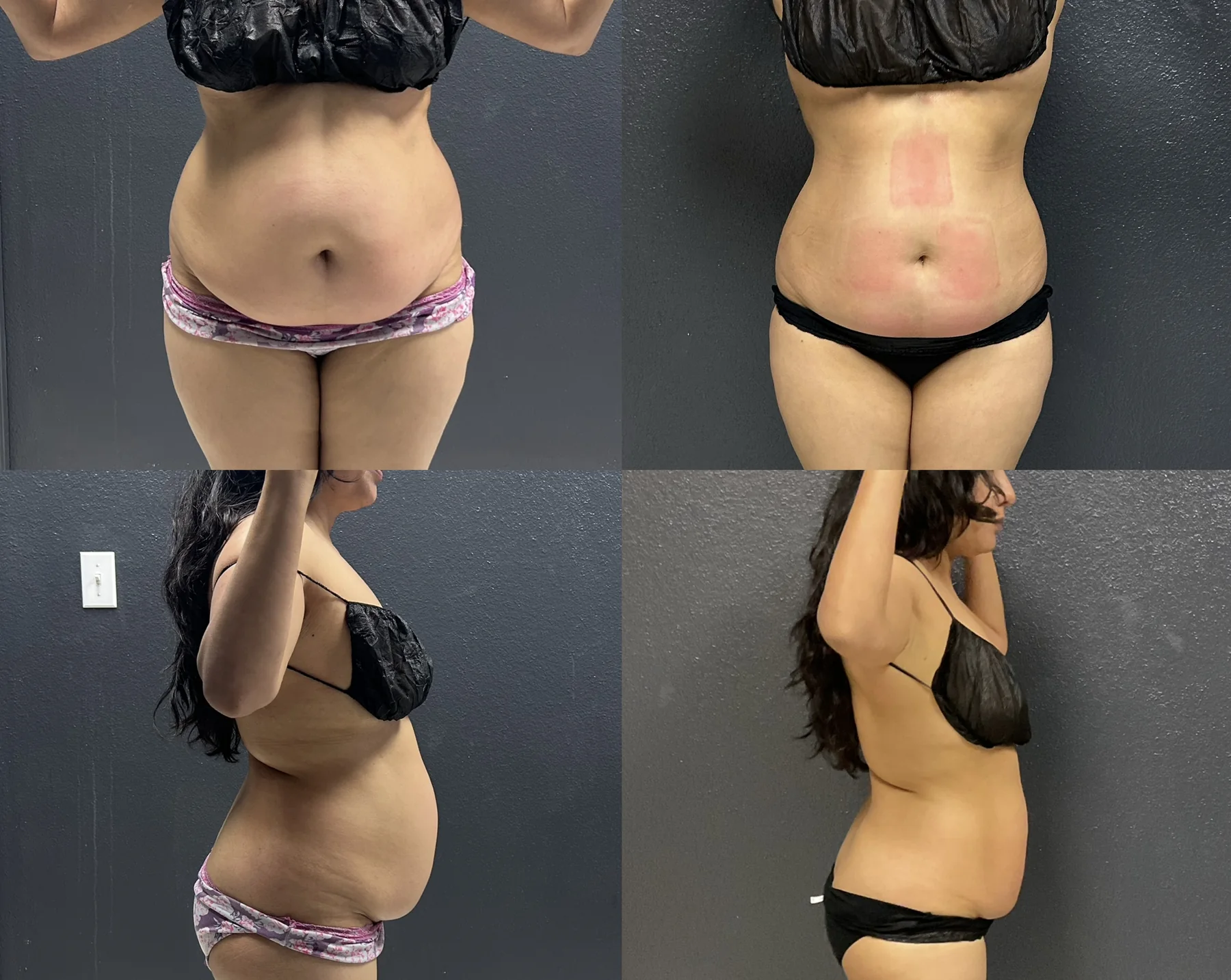 Actual Grace MedSpa DreamBody and EvolveX multi-angle body contouring result in Austin