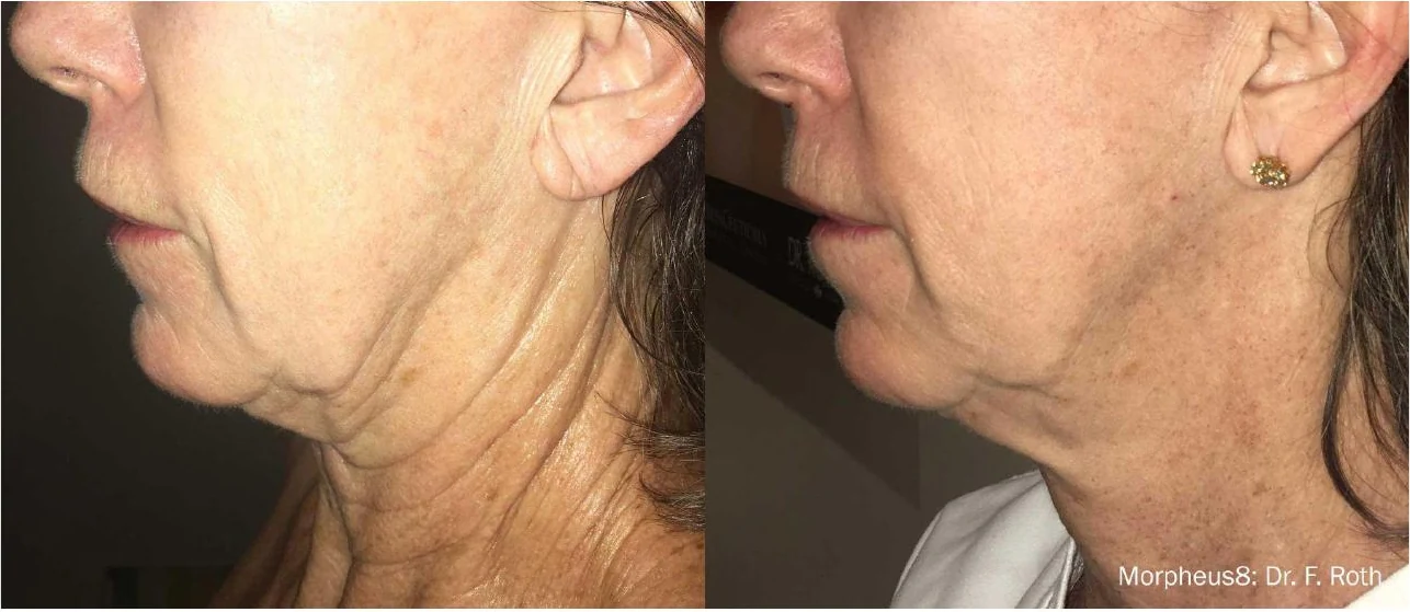 Manufacturer-supplied Morpheus8 before-and-after case showing neck laxity