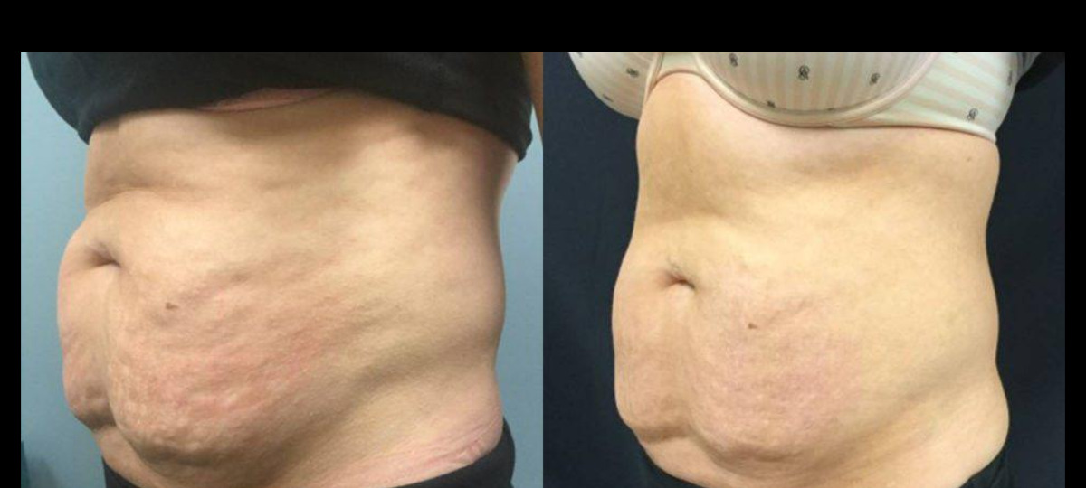 Manufacturer-supplied SculpSure before-and-after case showing the core and abdomen 17 weeks after a second treatment series