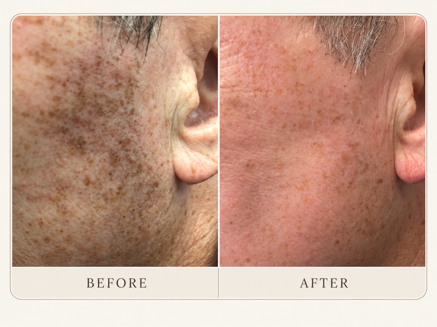 Manufacturer-supplied before-and-after showing facial pigmentation following MultiFrax resurfacing