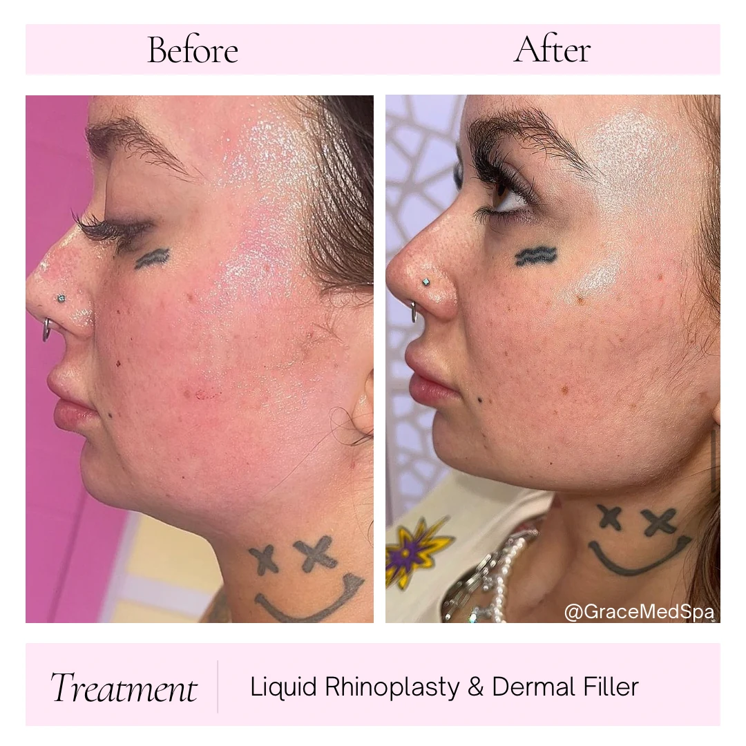 Grace patient before and after liquid rhinoplasty and dermal filler seen in profile