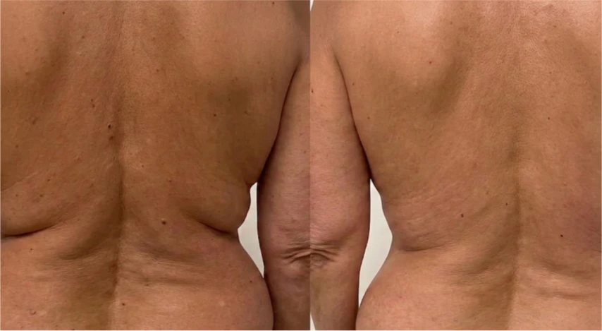 Manufacturer-supplied Morpheus8 before-and-after case showing back and bra-line skin laxity
